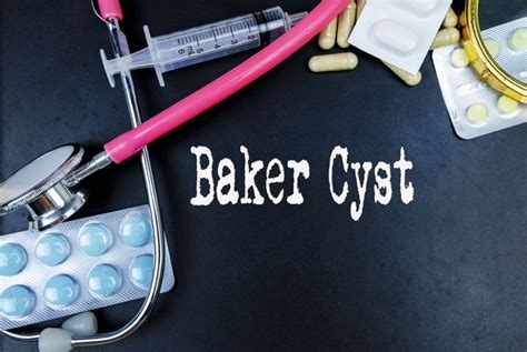 Baker’s Cyst: Symptoms and Treatments - Health & Detox & Vitamins