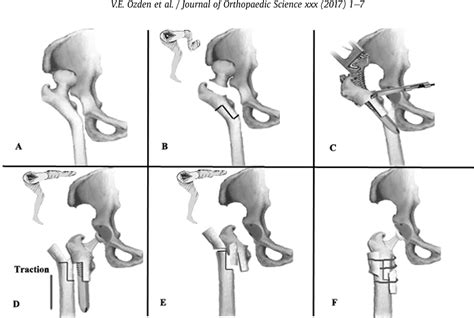 Total Hip Arthroplasty With Step Cut Subtrochanteric Femoral Shortening