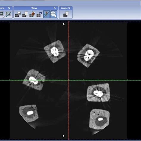 Axial View Of Cone Beam Computed Tomography Cbct Without Artifact