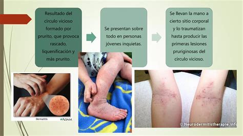 Eccema numular y Liquen Simple Crónico Neurodermatitis circunscrita PPT