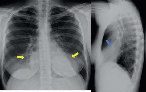 Acute Asthma Exacerbation | Radiology Key