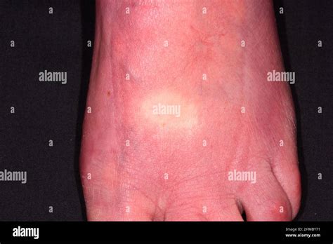 Peripheral Vascular Disease Stock Photo Alamy