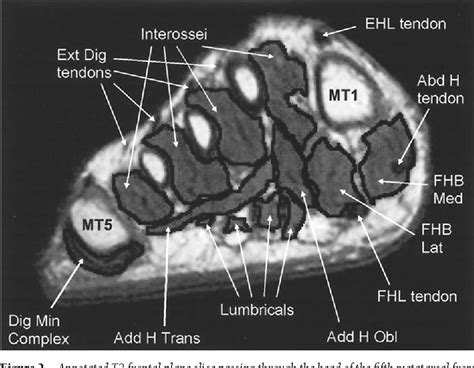 Figure 2 From Intrinsic Muscle Atrophy And Toe Deformity In The