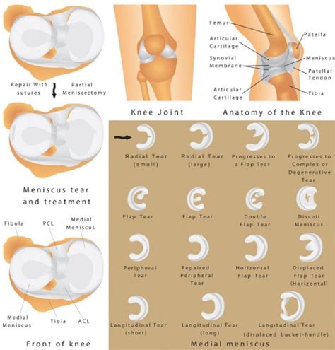 Meniscus Tear The Orthopedic And Sports Medicine Institute In Fort Worth