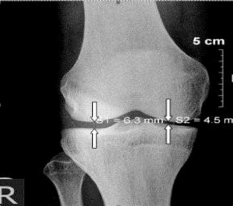 Figure 1 From Radiographic Evaluation Of Knee Joint Space Width Using