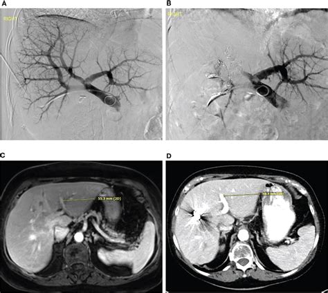 Portal Vein Embolization A Digitally Subtracted Percutaneous