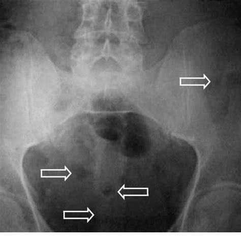 Pdf Multiple Myeloma Presenting With A Maxillary Lesion As The First Sign