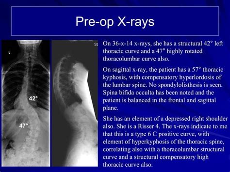 Case Review 12 14 Year Old Female With Adolescent Idiopathic