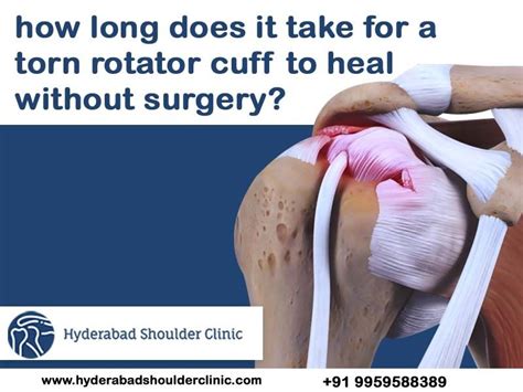 How long does it take for a torn rotator cuff to heal without surgery ...