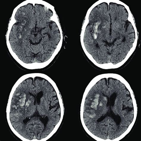 Non Contrast Ct Head Scan Acute Infarction In The Right Mca Territory Download Scientific