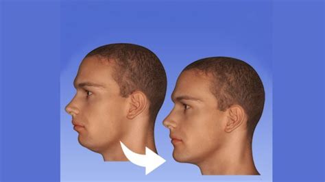 Jawline Surgery Before and After: A Transformative Journey to Facial ...