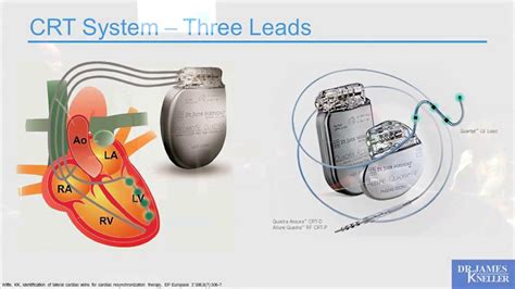 Cardiac Resynchronization Therapy Crt Making Non Response A Non