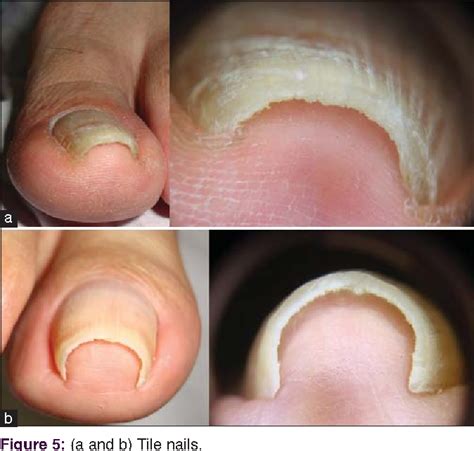 Pincer Nail Renal Disease Nail Ftempo