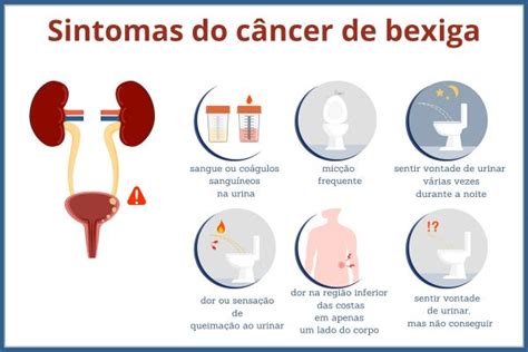 Câncer de bexiga sintomas causas tratamento Brasil Escola