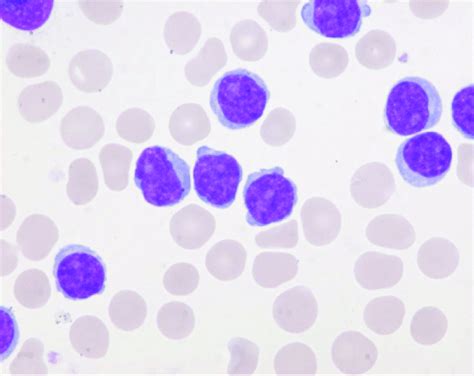 Small cells containing distinct nucleoli, basophilic cytoplasm, and ...