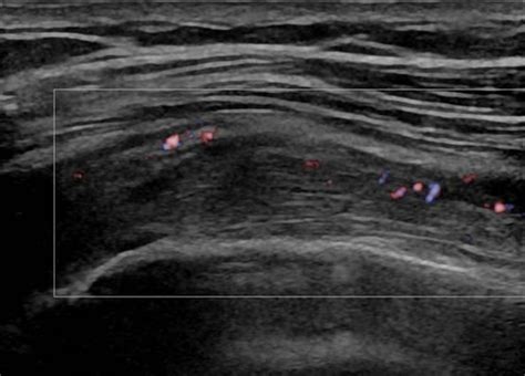 Musculoskeletal Joints And Tendons 61 Shoulder Case 611 Biceps