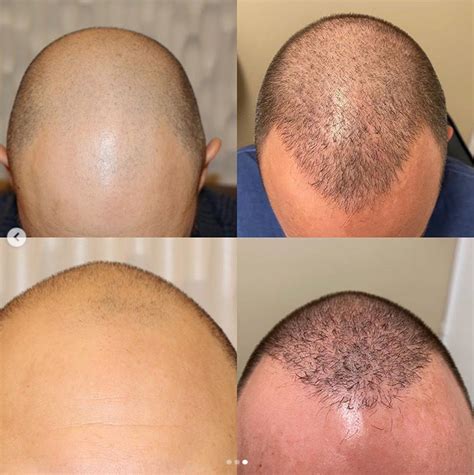 Male Hair Loss Success Story I Considered Having Hair Loss Treatment