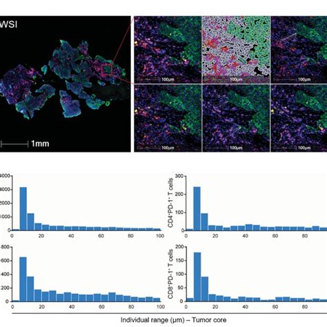 Spatial Analysis Of Tumor Infiltrating T Cells In ESCC A Schematic