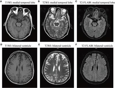 Frontiers Case Report Successful Treatment Of An Anti D R And Dppx