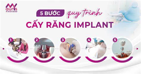 Quy trình cấy Implant chuẩn Y khoa