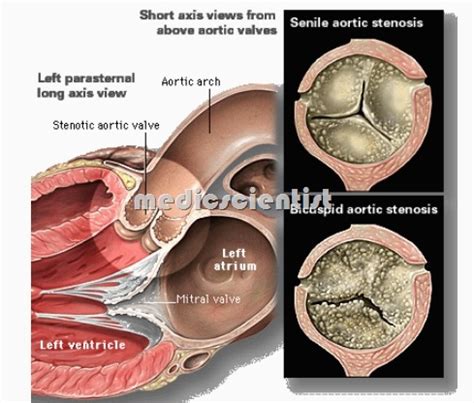 Estenosis Mitral Rubor Malar