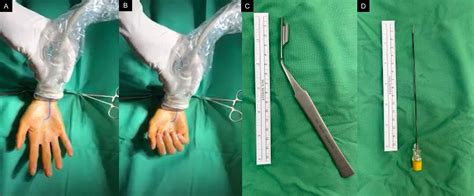 Dynamic Ultrasound For Evaluating The Adequacy Of Median Nerve Decompression Following Minimally