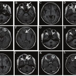 Brain magnetic resonance imaging (MRI). (A-F) Initial MRI evaluation ...