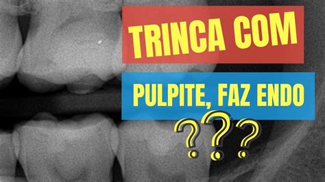 Qual A Necessidade De Fazer Endo Em Um Dente Trinca E Pulpite