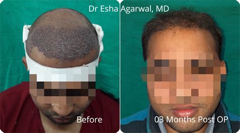 Hair Transplant Results Hair Transplant Before After Photos Ghaziabad