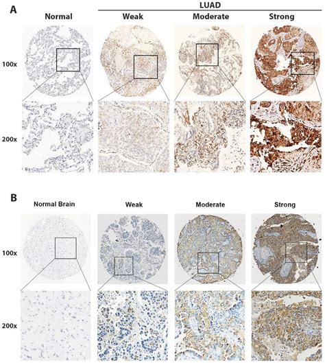 In Situ Detection Of P4HA2 In LUAD And LUAD BM Cases Representative