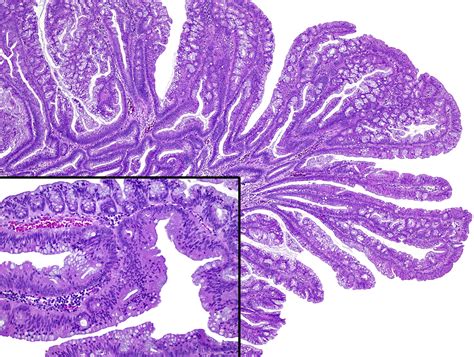 Serrated Colorectal Polyps And Polyposis Diagnostic Histopathology