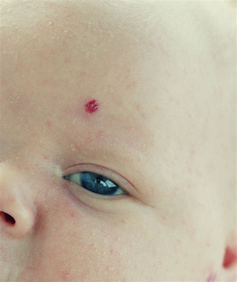 Mortensen Hemangiomas