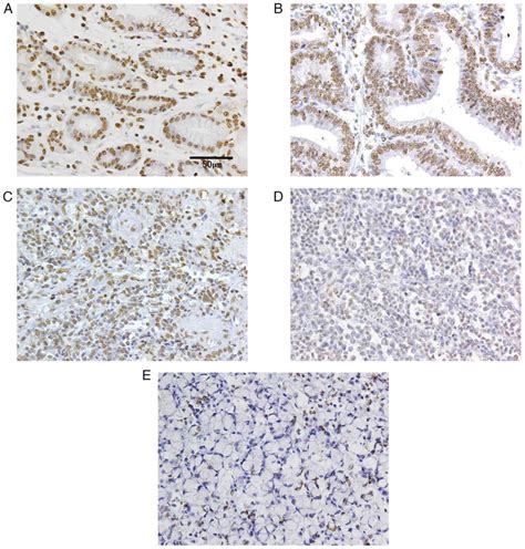 Peroxisome Proliferator‑activated Receptor‑α Expression Is Associated