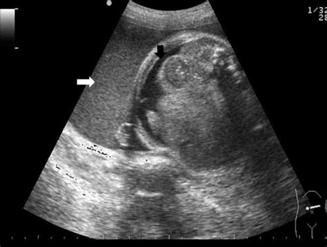 Prenatal Sonographic Diagnosis Of Fetal Persistent Urogenital Sinus