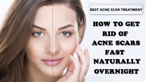 How To Get Rid Of Acne Scars According To Dermatologists Cosmetic News