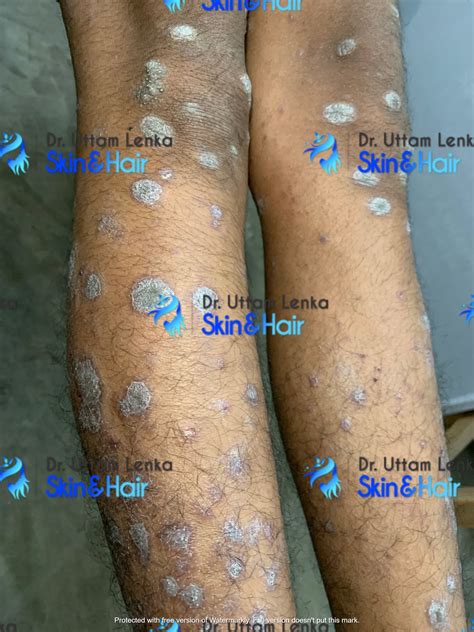 Gallery Advanced Diagnosis And Treatment Dr Uttam Lenkas Skin