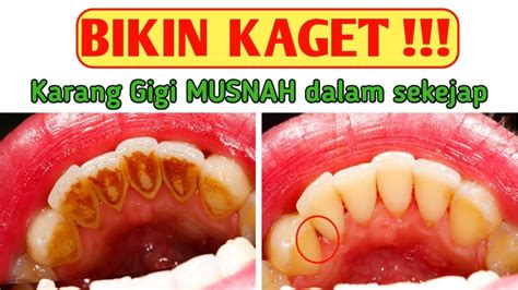 BIKIN KAGET Karang Gigi Hilang Dalam 5 Menit Cara Menghilangkan