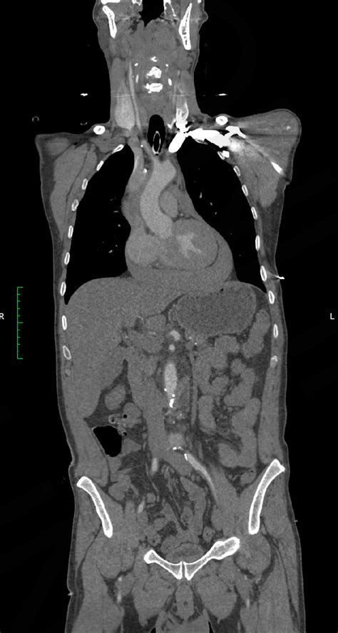 Chest Contrast Enhanced Ct Scan Obtained At The Level Of The Ventricles