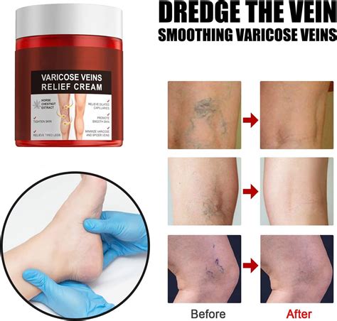 Anti Varicose Vein And Soothing Leg Cream Varicose Veins Relief Cream Varicose And Spider Veins