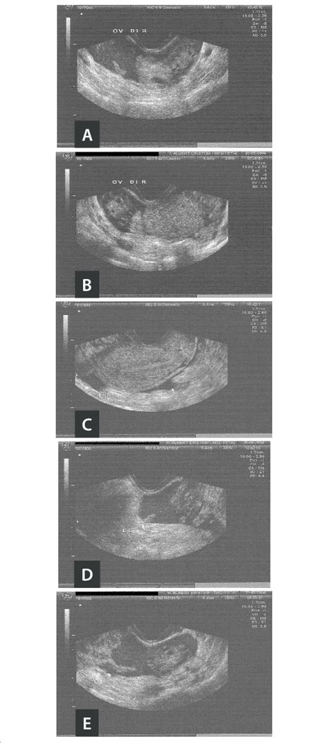 Transvaginal Ultrasound On The Ectopic Pregnancy Left A And B Right Download Scientific