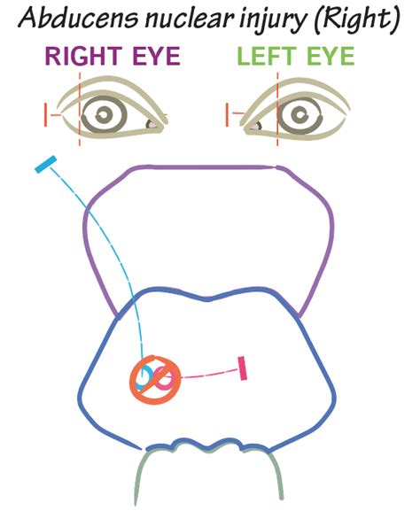 Neuroanatomy Glossary 6th Nerve Palsy Ditki Medical And Biological