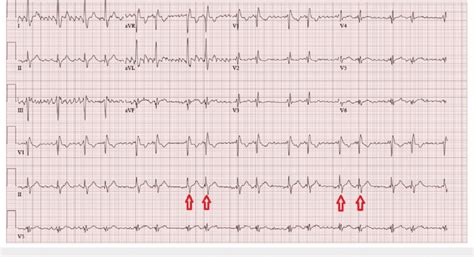 Ventricular Bigeminy