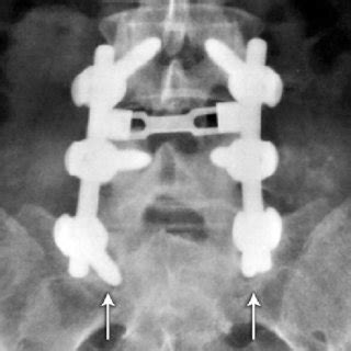 Anteroposterior Radiography Of The Lumbosacral Spine Showing Complete