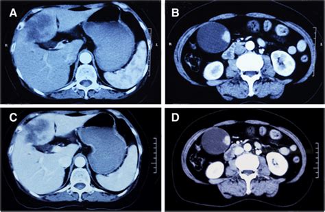 Synchronous Cancers Of Gallbladder Carcinoma And Combined