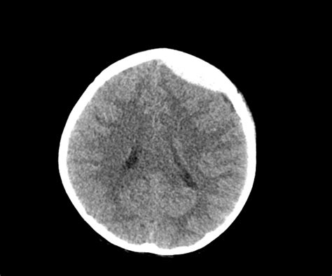 Acute Epidural Hematoma Image