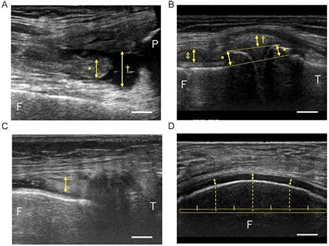 Ultrasonographic Changes Of The Knee Joint Reflect Symptoms Of Early