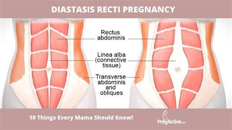 Post Pregnancy Abdominal Muscles Eoua Blog