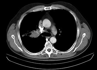 Chest CT scan (September 2011) -tumor in the right pulmonary hilus ...