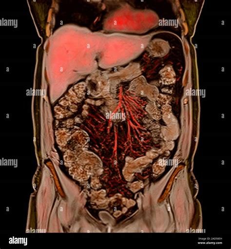 Abdominal Organs Coloured D Coronal Magnetic Resonance Imaging Mri