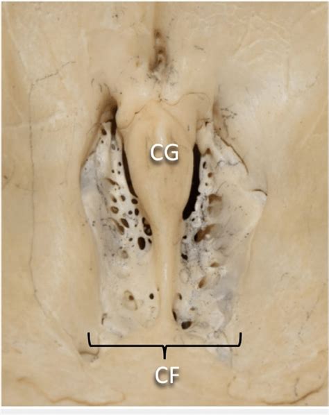 Close Up View Of Cranial Nerve Foramina Within Anterior Cranial Fossa